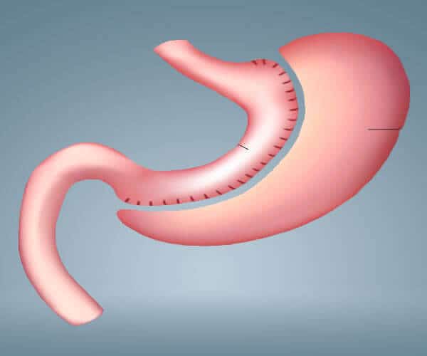 Img-SLEEVE-GASTRECTOMY1