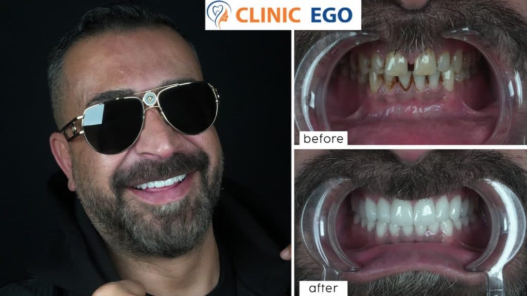 Hassas Di̇ş Tedavi̇si̇ 2 ali tareq istanbul dental clinic hollywood smile implant