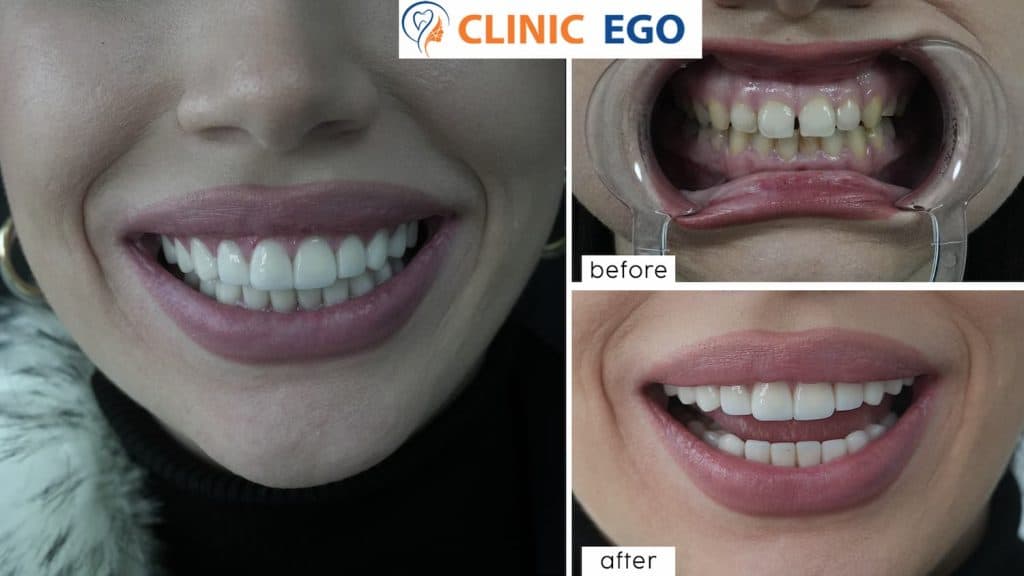 Tooth Fracture Treatment 4 beyza pehlivan istanbul dental clinic hollywood smile implant