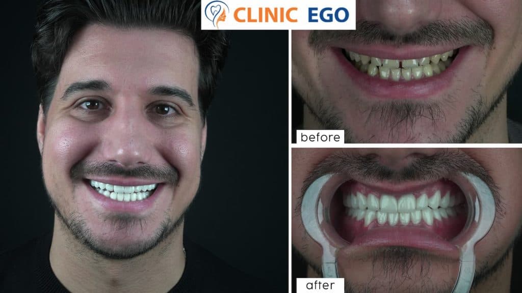Vollkiefer Implantatbehandlung 3 cihan anik istanbul dental clinic hollywood smile implant
