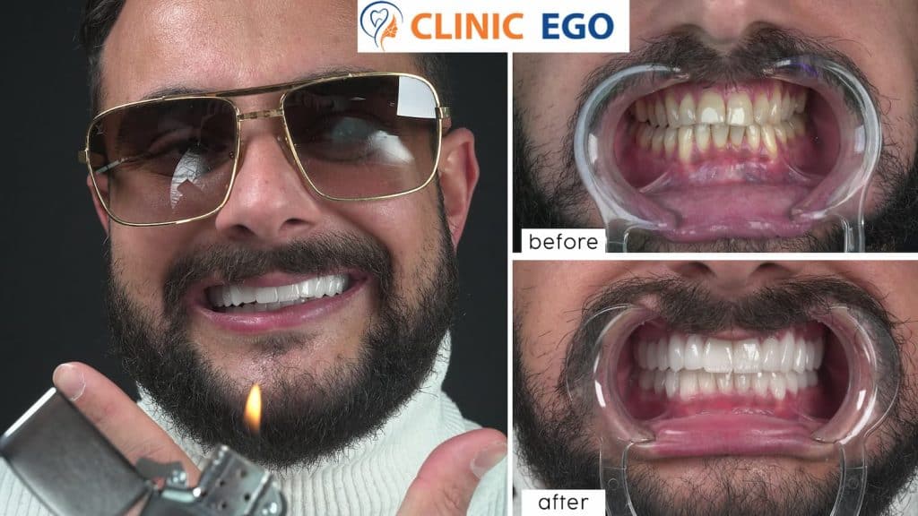 Vollkiefer Implantatbehandlung 1 gokhan umar istanbul dental clinic hollywood smile implant