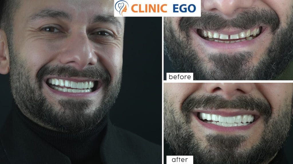 Tooth Fracture Treatment 3 ilyas yilmaz istanbul dental clinic hollywood smile implant
