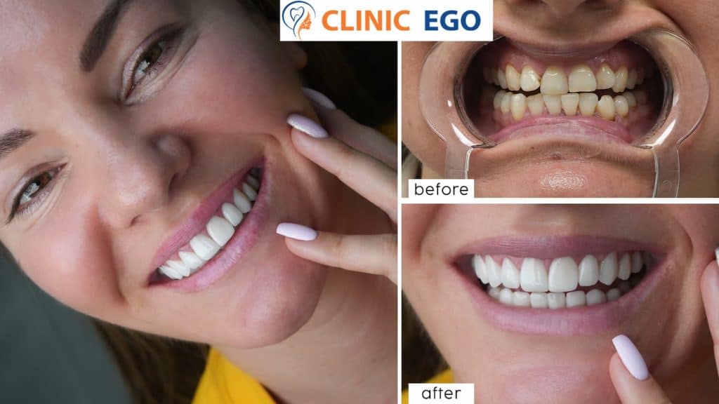 Hassas Di̇ş Tedavi̇si̇ 3 iula donici istanbul dental clinic hollywood smile implant