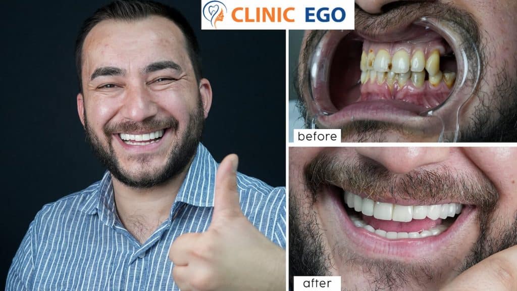 Vollkiefer Implantatbehandlung 4 salih battalbas istanbul dental clinic hollywood smile implant