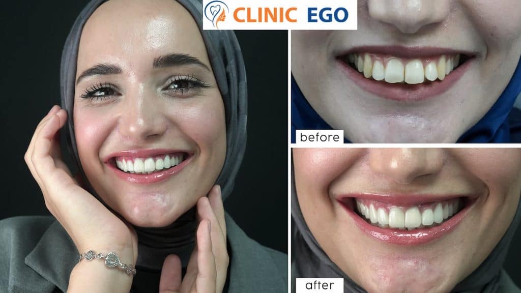 Hassas Di̇ş Tedavi̇si̇ 1 selma ozdemir istanbul dental clinic hollywood smile implant