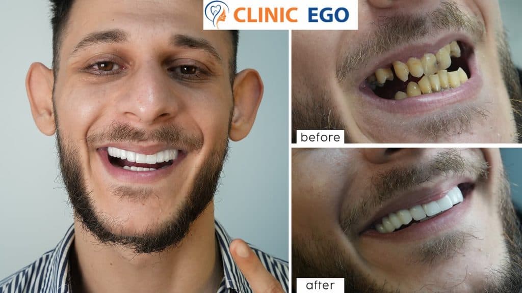 Hassas Di̇ş Tedavi̇si̇ 4 varban stanchev istanbul dental clinic hollywood smile implant