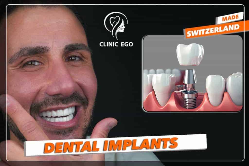 Was Sind Zahnimplantate? Ein Umfassender Leitfaden 2 dental implants istanbul dental clinic