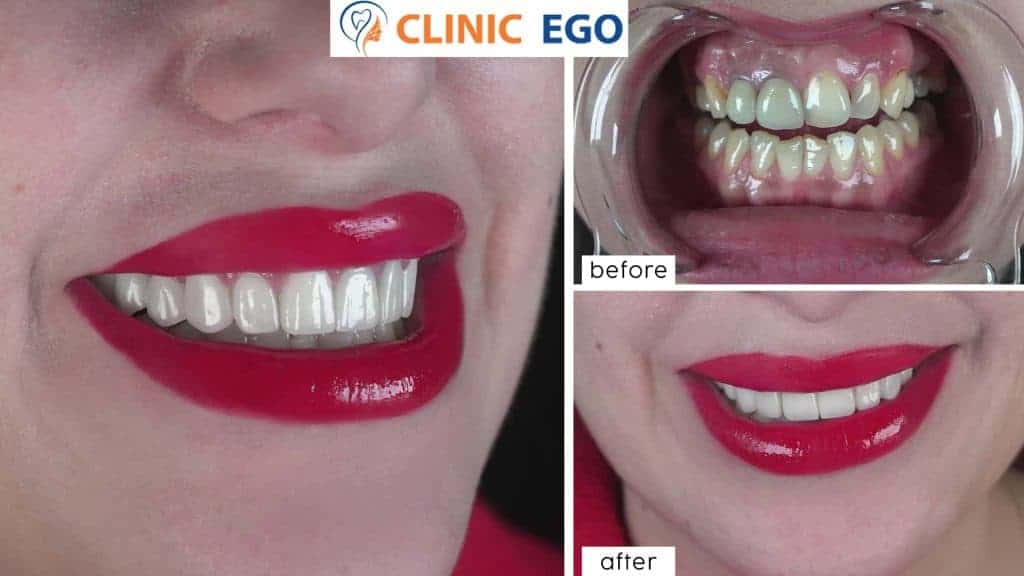 Vollkiefer Implantatbehandlung 2 grup2 gulsah tan istanbul dental clinic hollywood smile implant