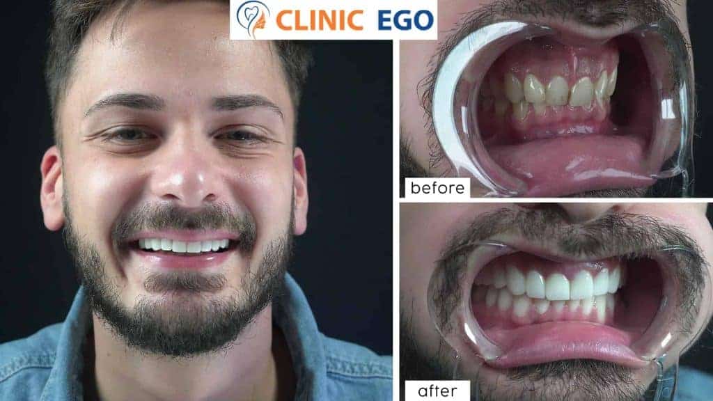 Tooth Fracture Treatment 1 grup4 furkan kirca istanbul dental clinic hollywood smile implant