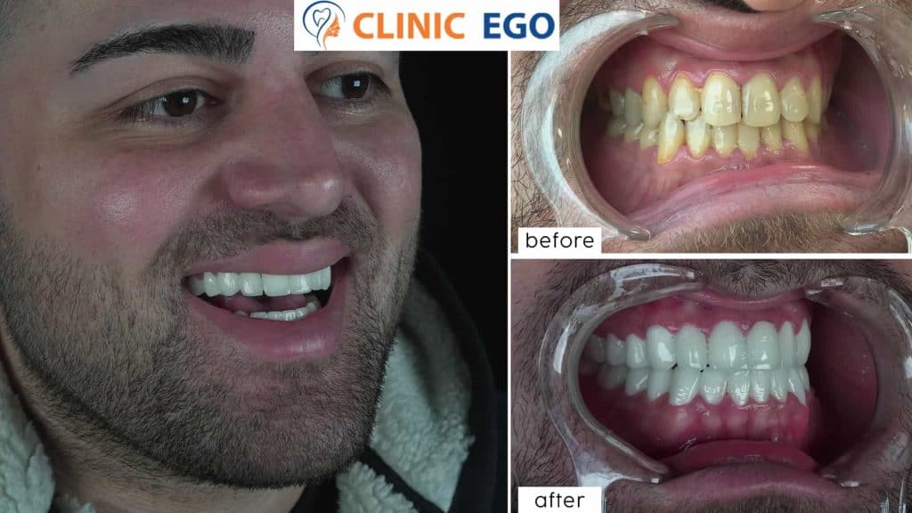 Single Tooth Implant Treatment 3 grup6 berke batuk istanbul dental clinic hollywood smile implant