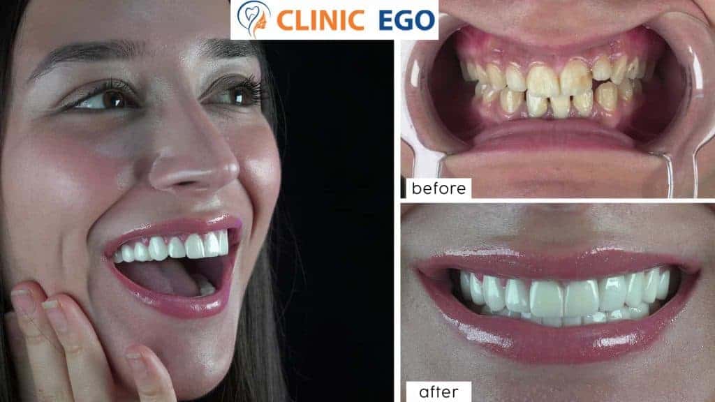 Single Tooth Implant Treatment 4 grup6 gaye devuk istanbul dental clinic hollywood smile implant