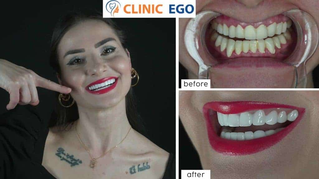 Single Tooth Implant Treatment 1 grup6 gizem sasa istanbul dental clinic hollywood smile implant