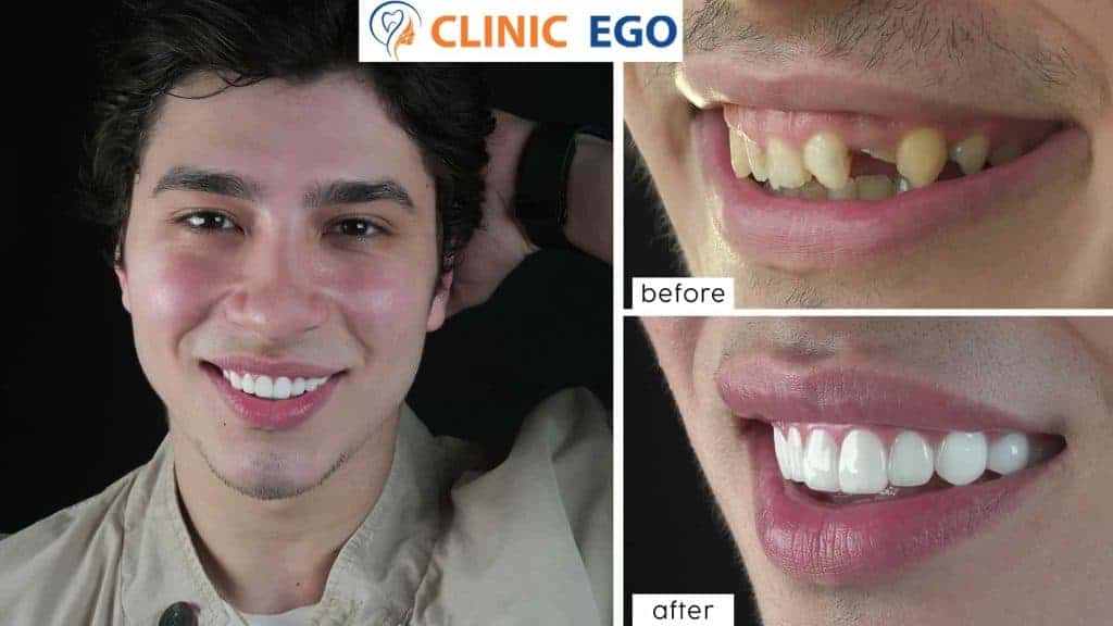 Single Tooth Implant Treatment 2 grup6 haktan cicek istanbul dental clinic hollywood smile implant