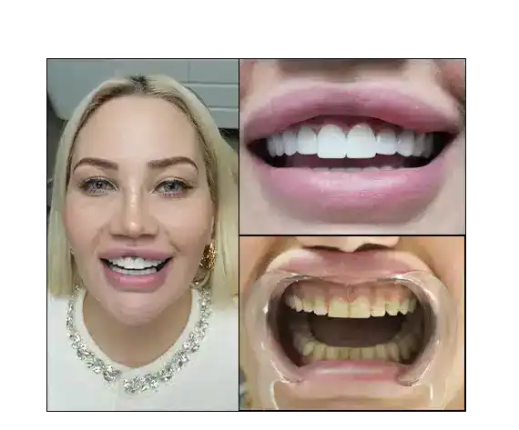 Zirkon Oder Emax? Welche Zahnkrone Ist Die Richtige Für Sie? 2 Zirconia or Emax