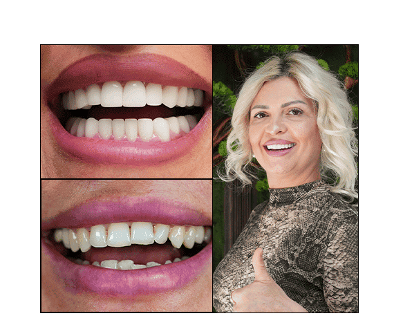 Zirkonyum Kaplamaların Dayanıklılığı: Kapsamlı Bir Rehber 1 advantage of Zirconium Crowns