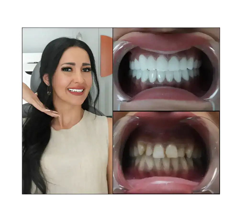 Zirkon Oder Emax? Welche Zahnkrone Ist Die Richtige Für Sie? 1 zirconium crowns vs emax crowns