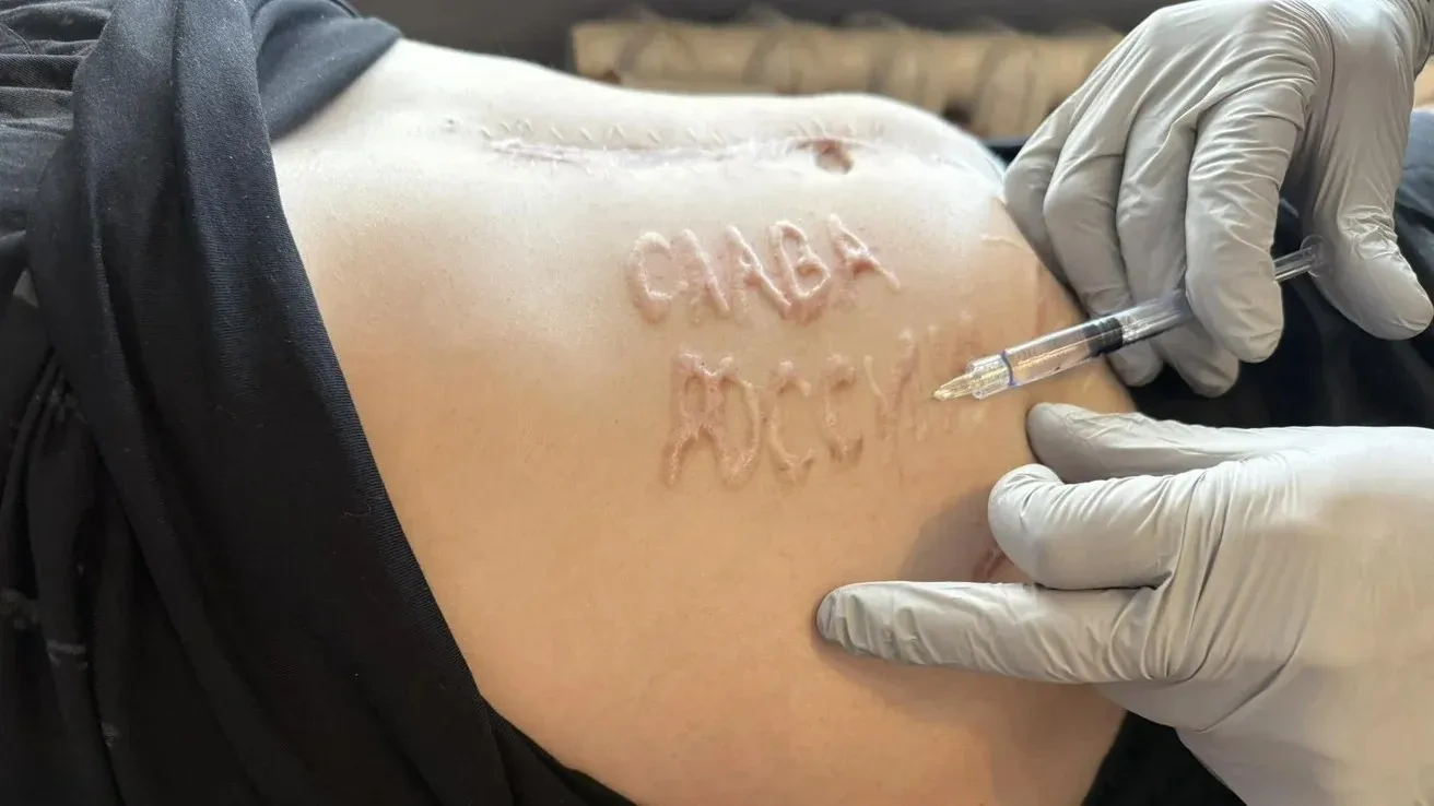 Стаття: «Слава Росії» на тілі українського військового: стало відомо, хто з лікарів міг випалити надпис