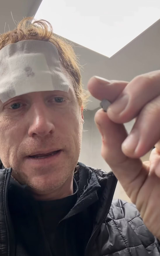 Зображення посту: Пораненому волонтеру Денису Христову витягли уламок після обстрілу