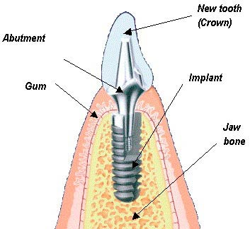 dental_implant