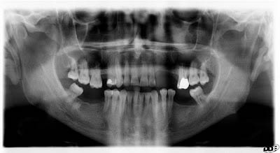 radiografia digitale