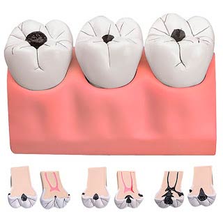 modellino-anatomico-carie-dentale