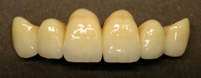 ponte_metallo_ceramica