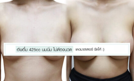 อัพอึ๋ม 425cc นมนิ่มไม่ต้องนวด หมอที่ เดอมาสเตอร์ จัดให้
