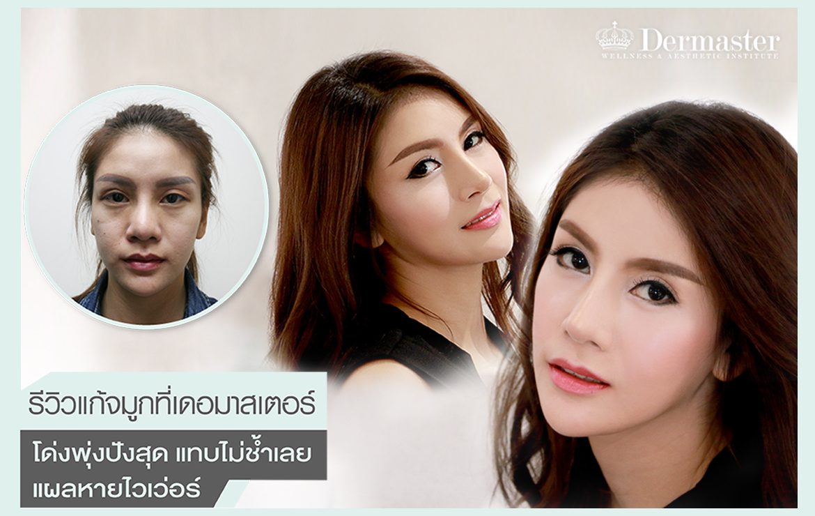 รีวิวแก้จมูกที่เดอมาสเตอร์ โด่งพุ่งปังสุด แทบไม่ช้ำเลย แผลหายไวเว่อร์