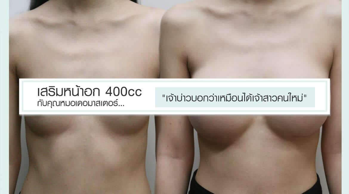 เสริมหน้าอก 400cc กับคุณหมอที่ เดอมาสเตอร์ … “เจ้าบ่าวบอกว่าเหมือนได้เจ้าสาวคนใหม่”