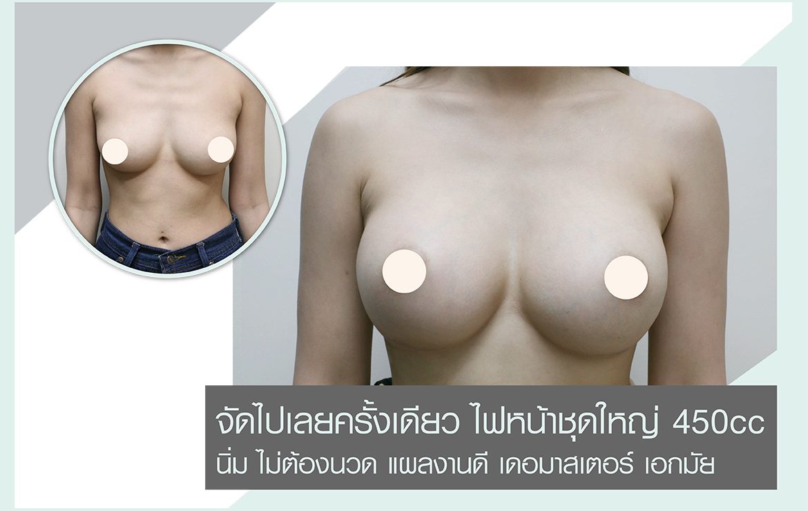 จัดไปเลยครั้งเดียว ไฟหน้าชุดใหญ่ 450cc นิ่ม ไม่ต้องนวด แผลงานดี เดอมาสเตอร์ เอกมัย