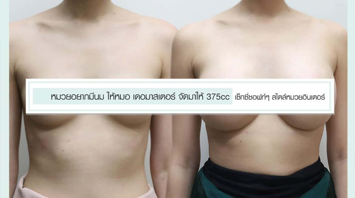 หมวยอยากมีนม ให้หมอ เดอมาสเตอร์ จัดมาให้ 375cc เซ็กซี่ซอฟท์ๆ สไตล์หมวยอินเตอร์