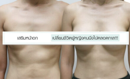 เสริมหน้าอกหมอ เปลี่ยนชีวิตผู้หญิงคนนึงไปตลอดกาล!!!