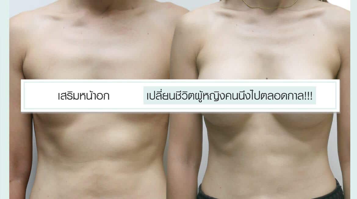 เสริมหน้าอกหมอ เปลี่ยนชีวิตผู้หญิงคนนึงไปตลอดกาล!!!