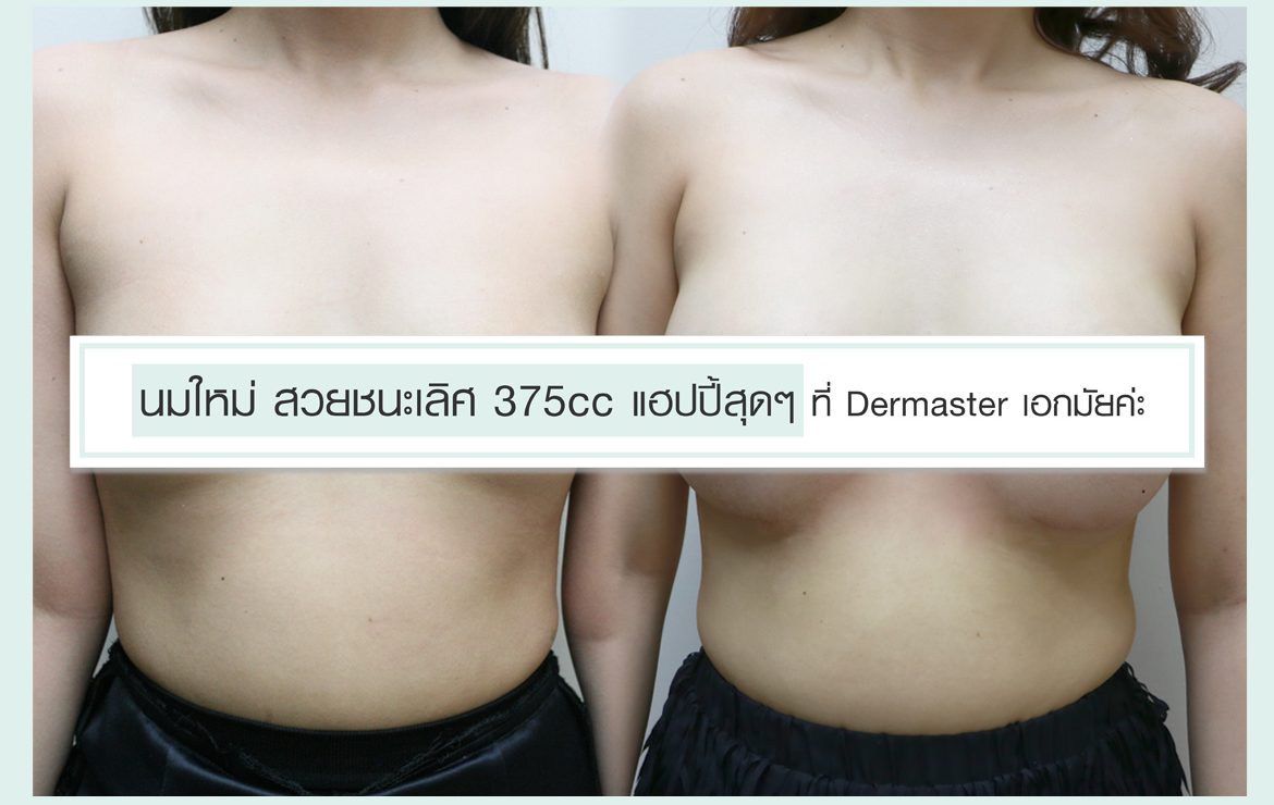 นมใหม่ สวยชนะเลิศ 375cc แฮปปี้สุดๆ ที่ Dermaster เอกมัยค่ะ