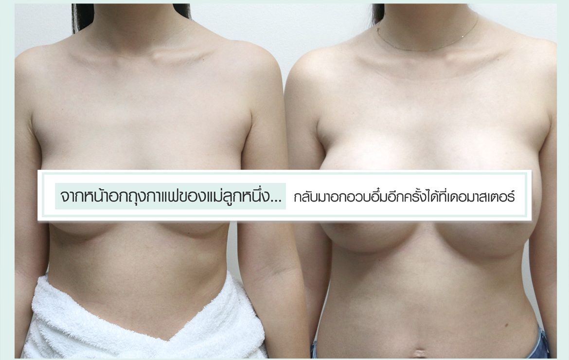 จากหน้าอกถุงกาแฟของแม่ลูกหนึ่ง…กลับมาอกอวบอึ๋มอีกครั้งได้ที่เดอมาสเตอร์