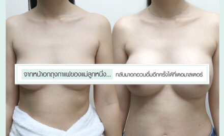 จากหน้าอกถุงกาแฟของแม่ลูกหนึ่ง…กลับมาอกอวบอึ๋มอีกครั้งได้ที่เดอมาสเตอร์