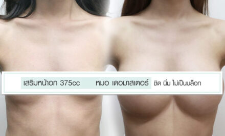เสริมหน้าอก 375cc หมอที่ เดอมาสเตอร์ ชิด นิ่ม ไม่เป็นบล็อก