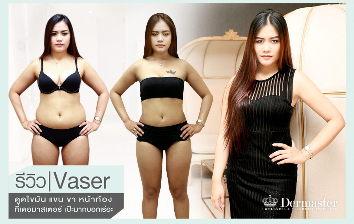 รีวิว Vaser ดูดไขมัน แขน ขา หน้าท้อง ที่เดอมาสเตอร์ เป๊ะมากบอกเร่อะะะ