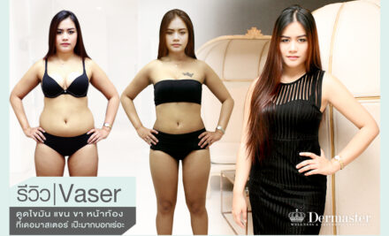 รีวิว Vaser ดูดไขมัน แขน ขา หน้าท้อง ที่เดอมาสเตอร์ เป๊ะมากบอกเร่อะะะ