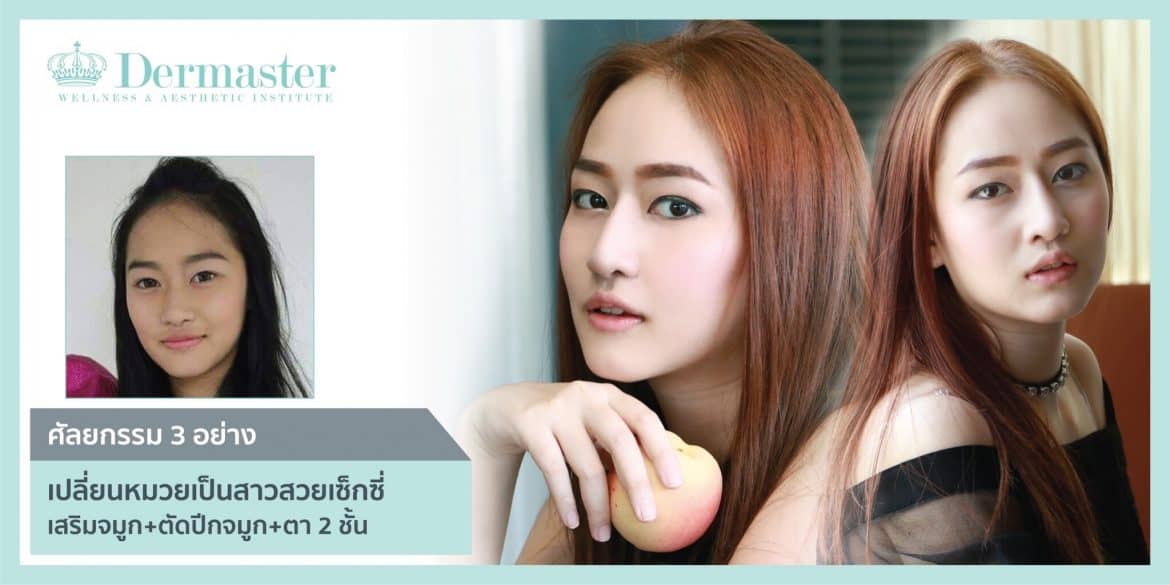 ศัลยกรรม 3 อย่าง เปลี่ยนเด็กหน้ามึน เป็นเด็กสวยหน้าใส วัยรุ่นสยาม ซีรีย์ : เสริมจมูก+ตัดปีกจมูก+ตา 2 ชั้น