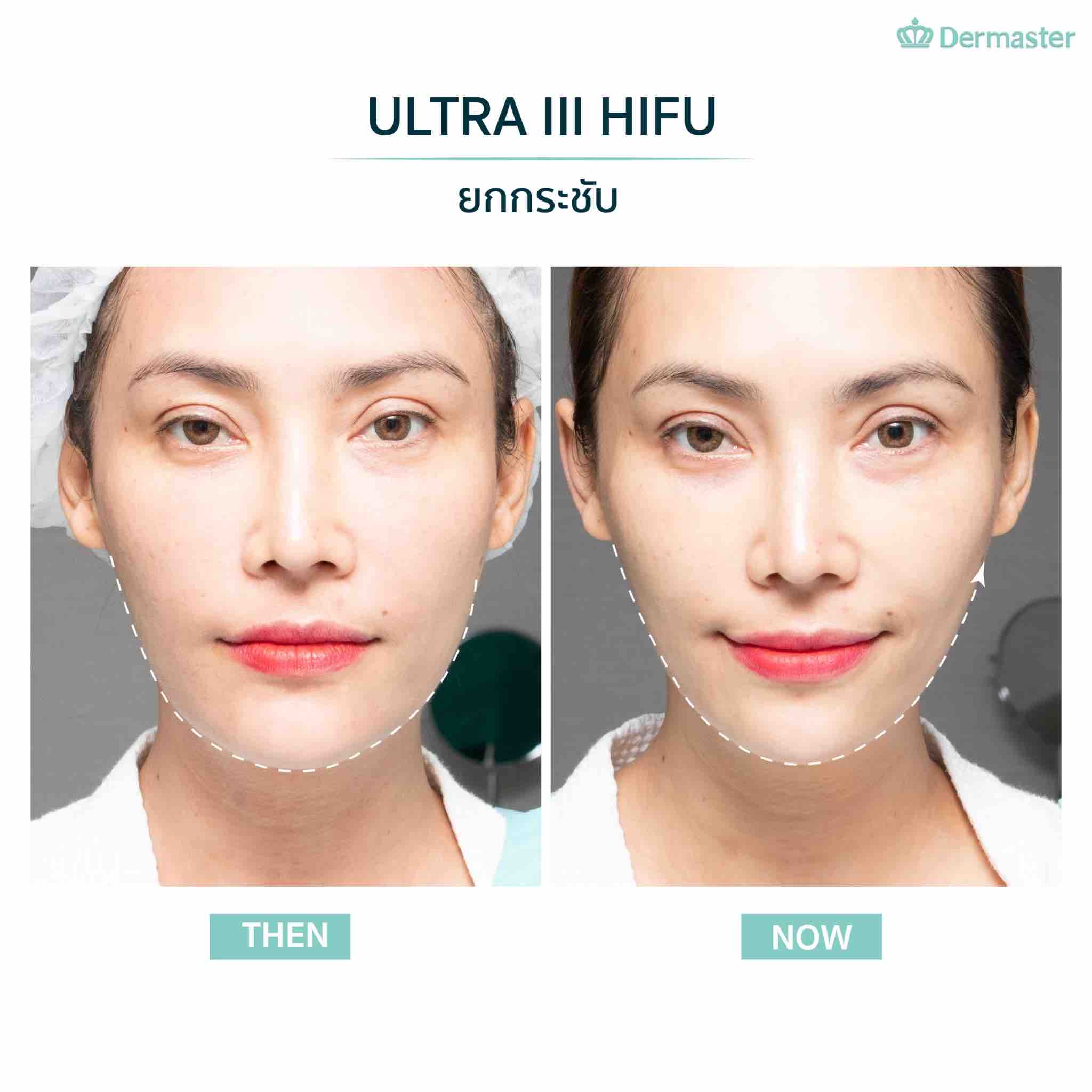 dermaster_ultra_formerIII