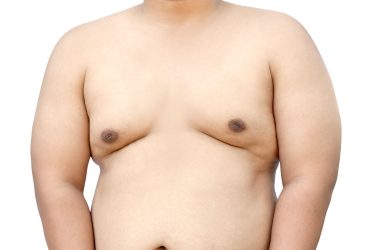 男性乳房缩小术