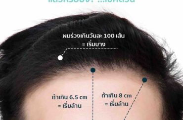 รู้ไว้ก่อนปลูกผม – Hair Transplant