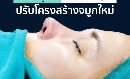 รีวิว – แก้จมูกด้วยเทคนิค Open ซิลิโคน+รองปลายด้วยกระดูกอ่อนหลังหู (คุณมะเมี่ยว)