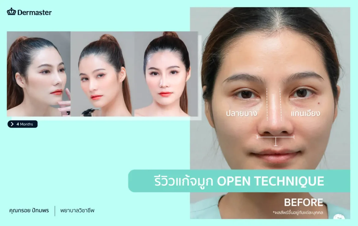 รีวิว – แก้จมูกด้วยเทคนิค Open ซิลิโคน+รองปลายด้วยกระดูกอ่อนหลังหู (คุณกรอย)