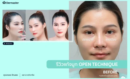 รีวิว – แก้จมูกด้วยเทคนิค Open ซิลิโคน+รองปลายด้วยกระดูกอ่อนหลังหู (คุณกรอย)