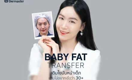 คลิปรีวิว – เติมไขมันหน้า (Baby Fat Transfer) ด้วยเทคนิค NANO Fat Grafting ของคุณพิงกี้