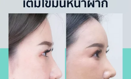 คลิปรีวิว – เติมไขมันหน้า (Baby Fat Transfer) ด้วยเทคนิค NANO Fat Grafting ของคุณก้อย