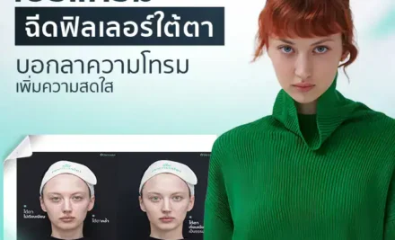 โปรแกรมฉีดฟิลเลอร์ใต้ตา บอกลาความโทรม เพิ่มความสดใส