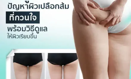 เซลลูไลท์ ปัญหาผิวเปลือกส้มที่กวนใจ พร้อมวิธีดูแลให้ผิวเรียบเนียนขึ้น